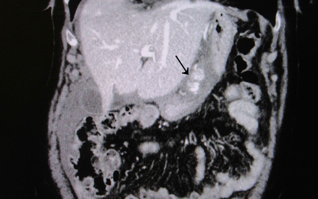 Un caso di rottura idiopatica dell’arcata arteriosa della piccola curvatura gastrica