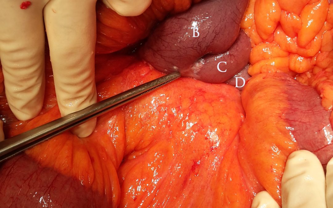 Fibrosi mesenterica correlata a tumore neuroendocrino (carcinoide) dell’intestino tenue