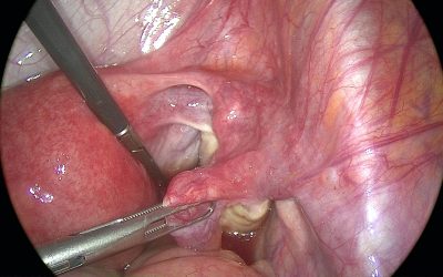 Osservazioni sull’uso della laparoscopia nella diagnosi differenziale tra appendicite e malattia infiammatoria pelvica