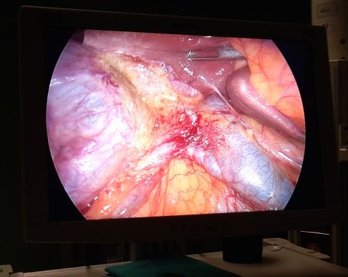 Guida alla riparazione di una lesione coledocica completa – Revisione: dicembre 2017