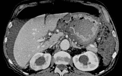 Rottura dello stomaco nell’adulto: presentazione di due casi