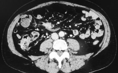 I tumori neuroendocrini del tenue