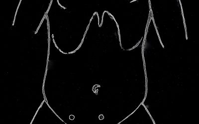 Breve nota su un approccio estetico per l’appendicectomia laparoscopica (Revisione: luglio 2018)