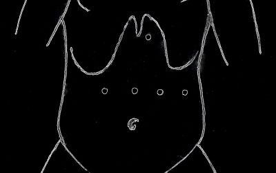 Miotomia secondo Heller e plastica secondo Dor per via laparoscopica: dettagli tecnici