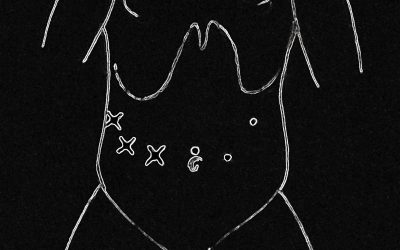 Tecnica dell’anastomosi epatico-digiunale per via laparoscopica