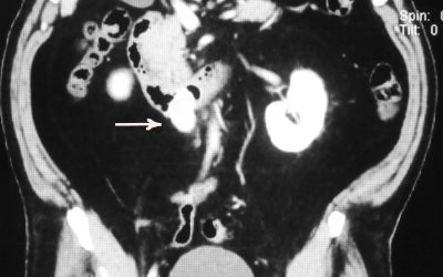 GIST duodenali: soluzioni chirurgiche e analisi di un caso clinico