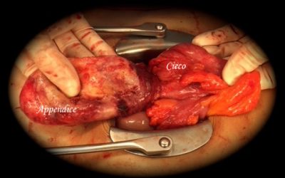 Un’appendice inconsueta