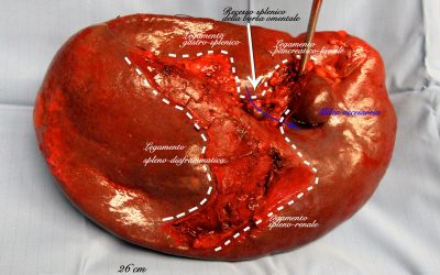 Mini-invasività nella splenectomia per via laparotomica