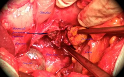 Perforazione di diverticolo duodenale paravateriano da duodenolita: segnalazione di un caso e osservazioni sul trattamento della perforazione diverticolare paravateriana