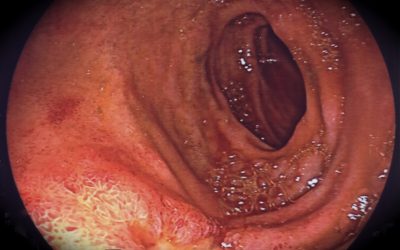 Trattamento dell’ileo biliare associato a fistola colecisto-duodenale: accorgimenti per ridurre la mortalità