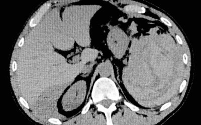 Esiste la rottura spontanea di milza? Un’insolita causa di rottura splenica non traumatica