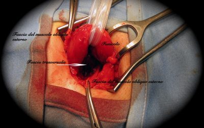 Ernioplastica inguinale con protesi interfasciale: note di tecnica chirurgica