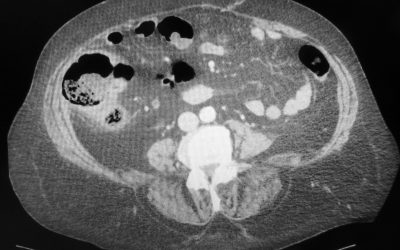 L’infarto del cieco