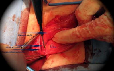 Chiusura di colostomia: tecnica chirurgica