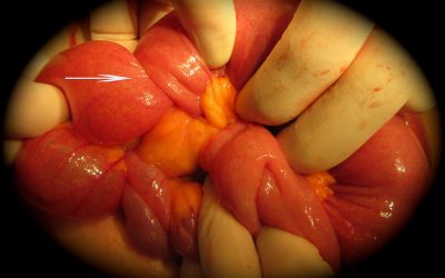 Intussuscezione intestinale nell’adulto