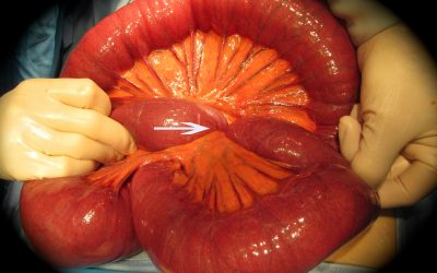 Il volvolo dell’intestino tenue nell’adulto