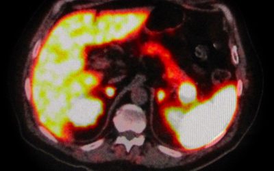 Nodulo intra-pancreatico non metastatico evidenziabile con RMN e 68Ga-DOTA-peptide PET/TC: resezione pancreatica o agobiopsia eco-endoguidata?