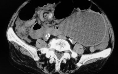 Un particolare caso di ernia interna del cieco