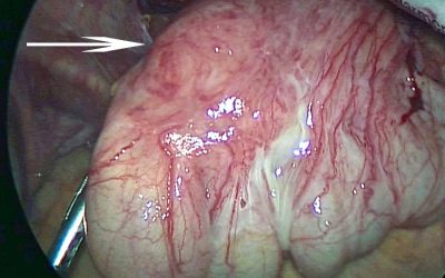 La diverticolite del cieco