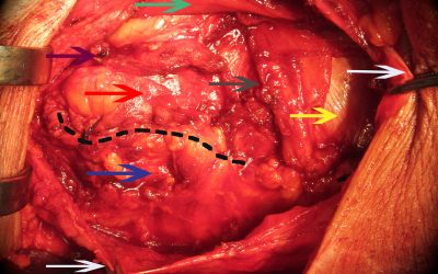 E’ opportuno prevenire il laparocele con una protesi biologica negli interventi di chiusura di colostomia?
