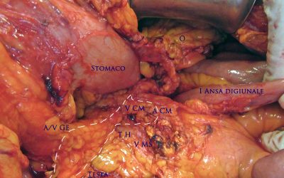  “Escissione mesocolica completa” o “escissione mesocolica appropriata” nel tumore del terzo medio del colon trasverso?