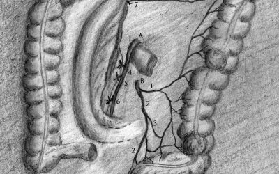 Breve nota sulla resezione colica nel trattamento del tumore del colon discendente e dei tumori sincroni del colon discendente e del sigma in esiti di emicolectomia destra – (Rev. aprile 2019)