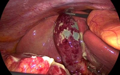 Videolaparocolecistectomia nella colecistite acuta litiasica. Introduzione alla tecnica chirurgica