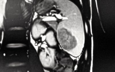 Neoformazione solida solitaria primitiva della milza: percorso diagnostico-terapeutico