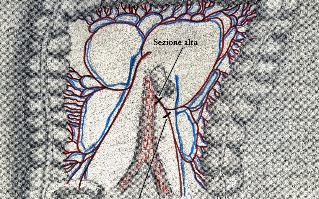 Opportuni criteri per definire l’estensione dell’escissione mesorettale consentono di scegliere appropriatamente tra sezione “alta” e sezione “bassa” dell’arteria mesenterica inferiore nelle resezioni colo-rettali per adenocarcinoma del retto