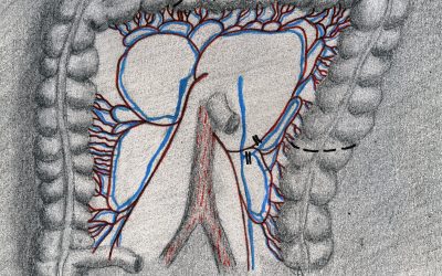 Resezione colica con conservazione della vena mesenterica inferiore per adenocarcinoma della flessura splenica: intervento palliativo o radicale?