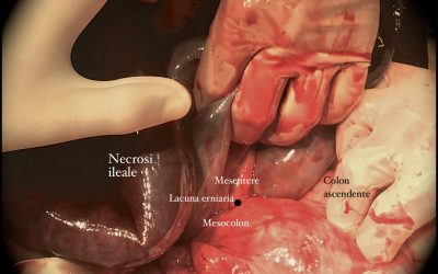 Erniazione transmesocolica retrociecale dell’intestino tenue complicata da strozzamento e da volvolo