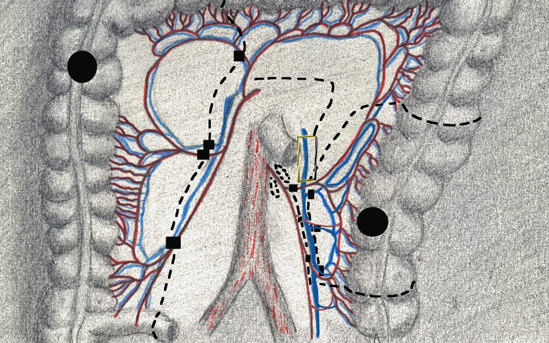 Resezione colica segmentaria sinistra con conservazione dei vasi mesenterici inferiori per adenocarcinoma tra colon discendente e sigma: indicazioni e aspetti tecnici