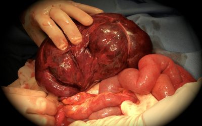 Il volvolo del cieco