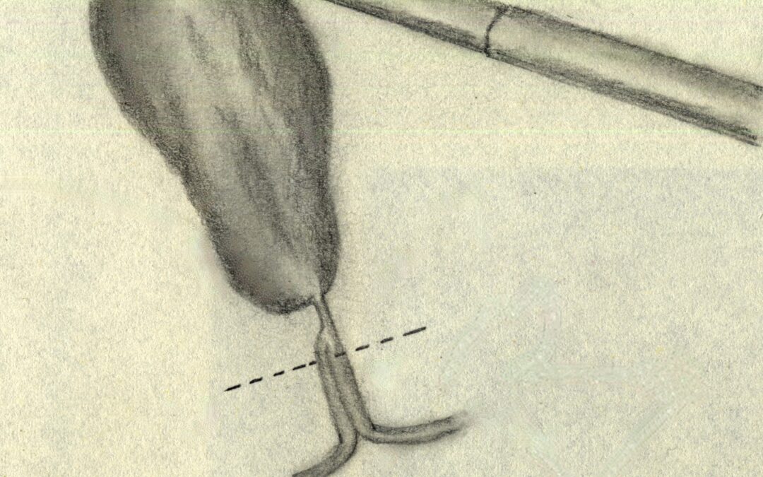 Il segno del doppio lume in corso di colecistectomia laparoscopica