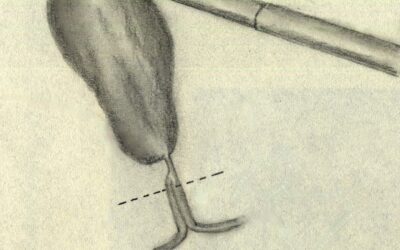 Il segno del doppio lume in corso di colecistectomia laparoscopica